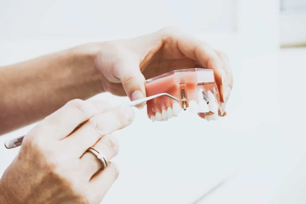 implantes dentales en Sevilla
